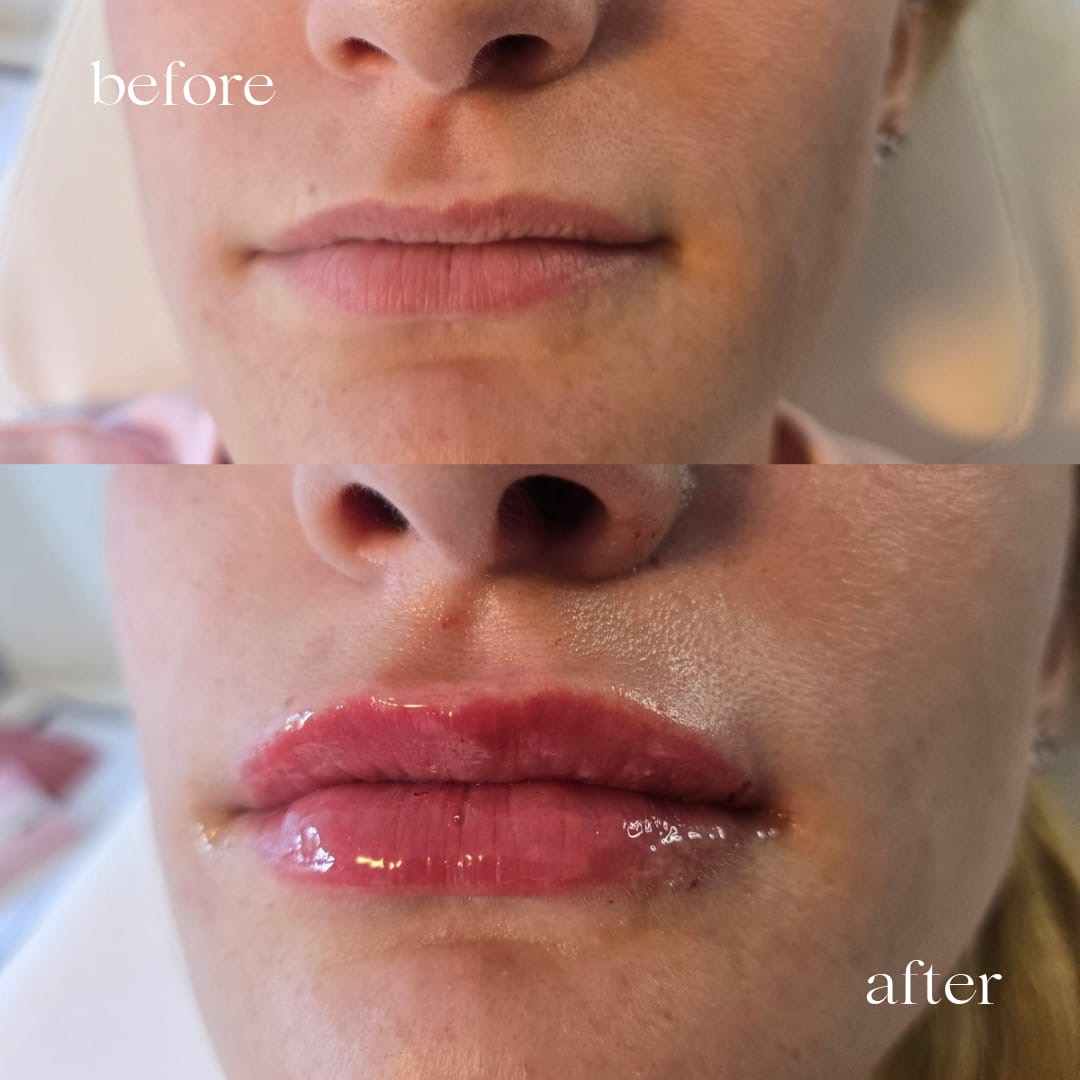 Before and after lip filler, close up
