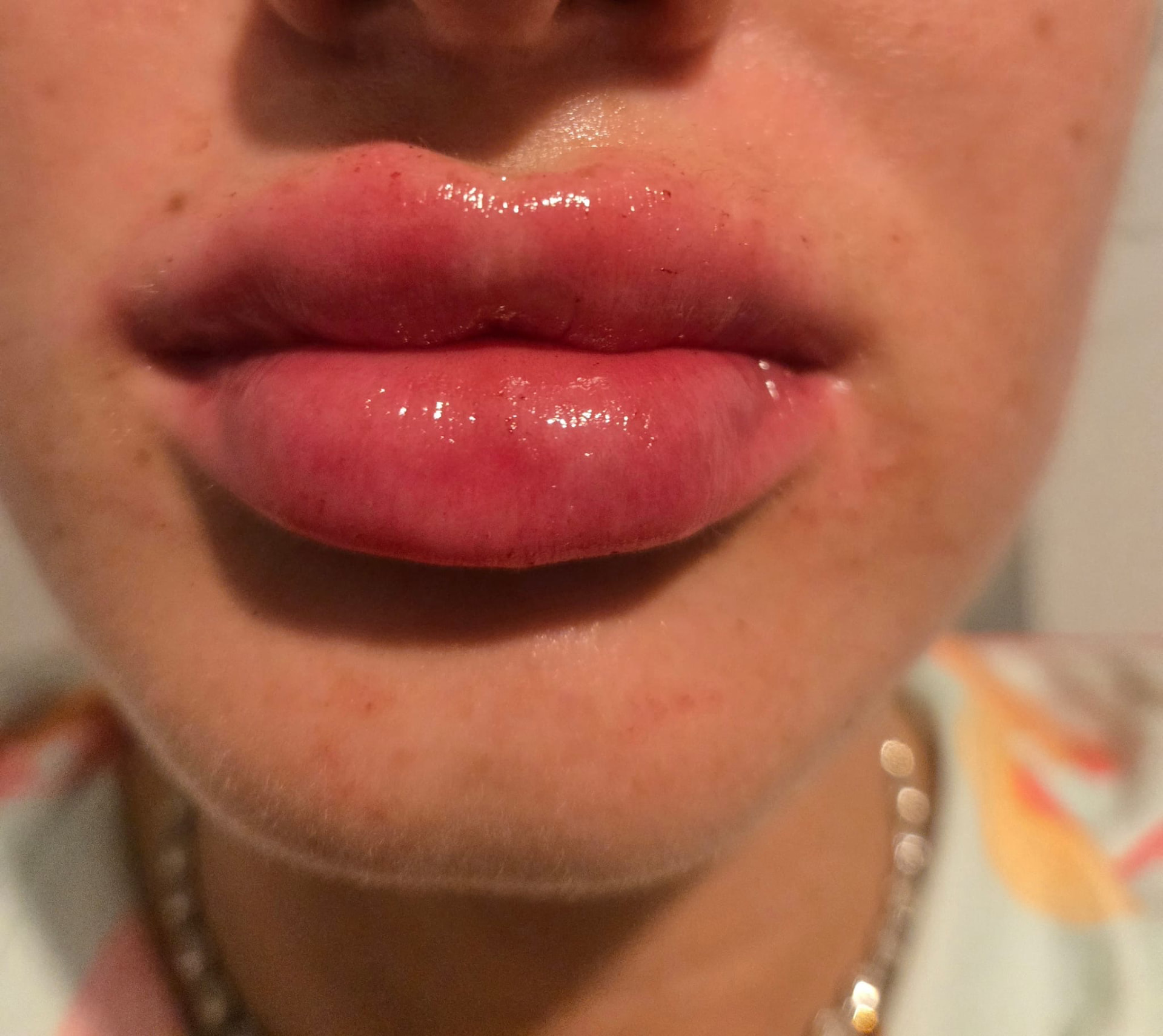 Lips immediately after a lip filler treatment, front view
