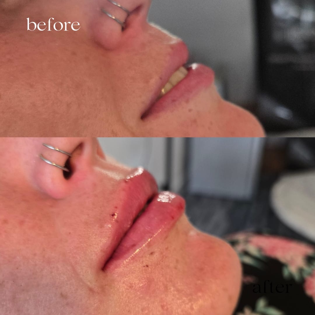 Before and after lip filler, side view