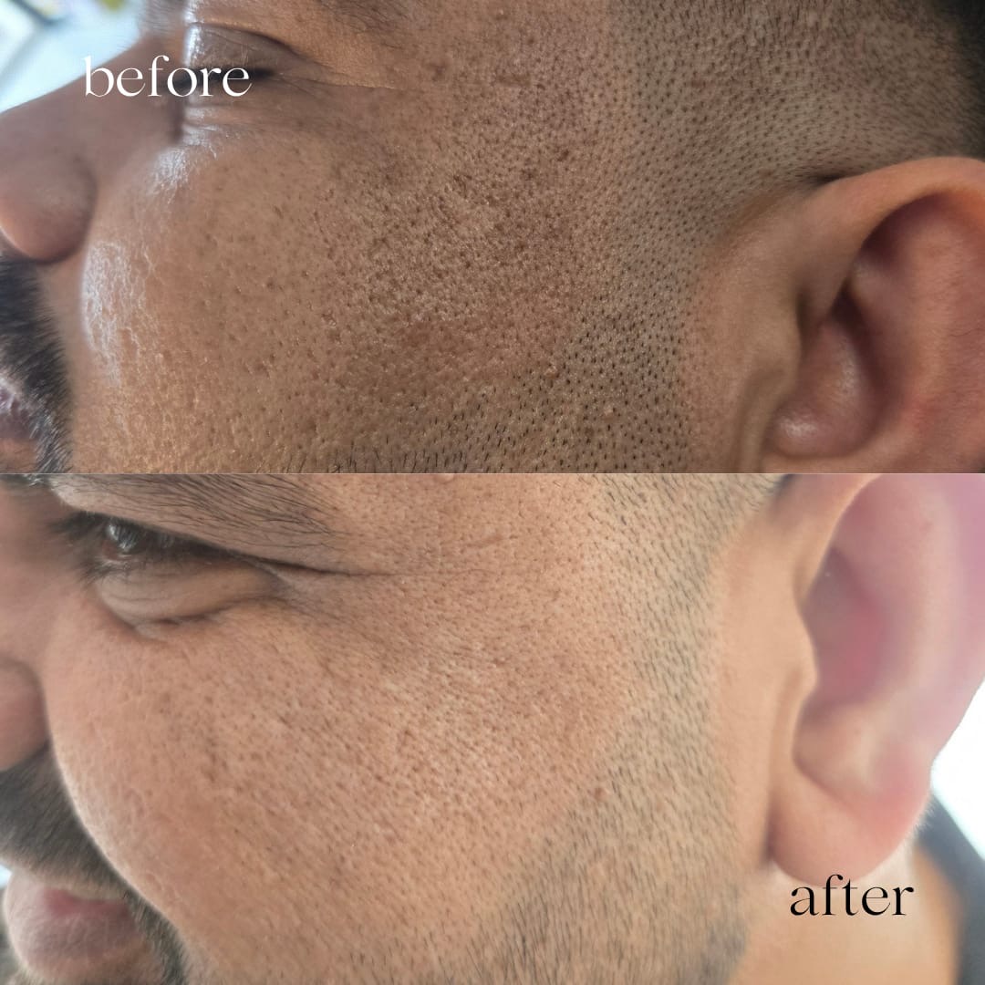 Before and after skin treatment on a male client, clearer texture