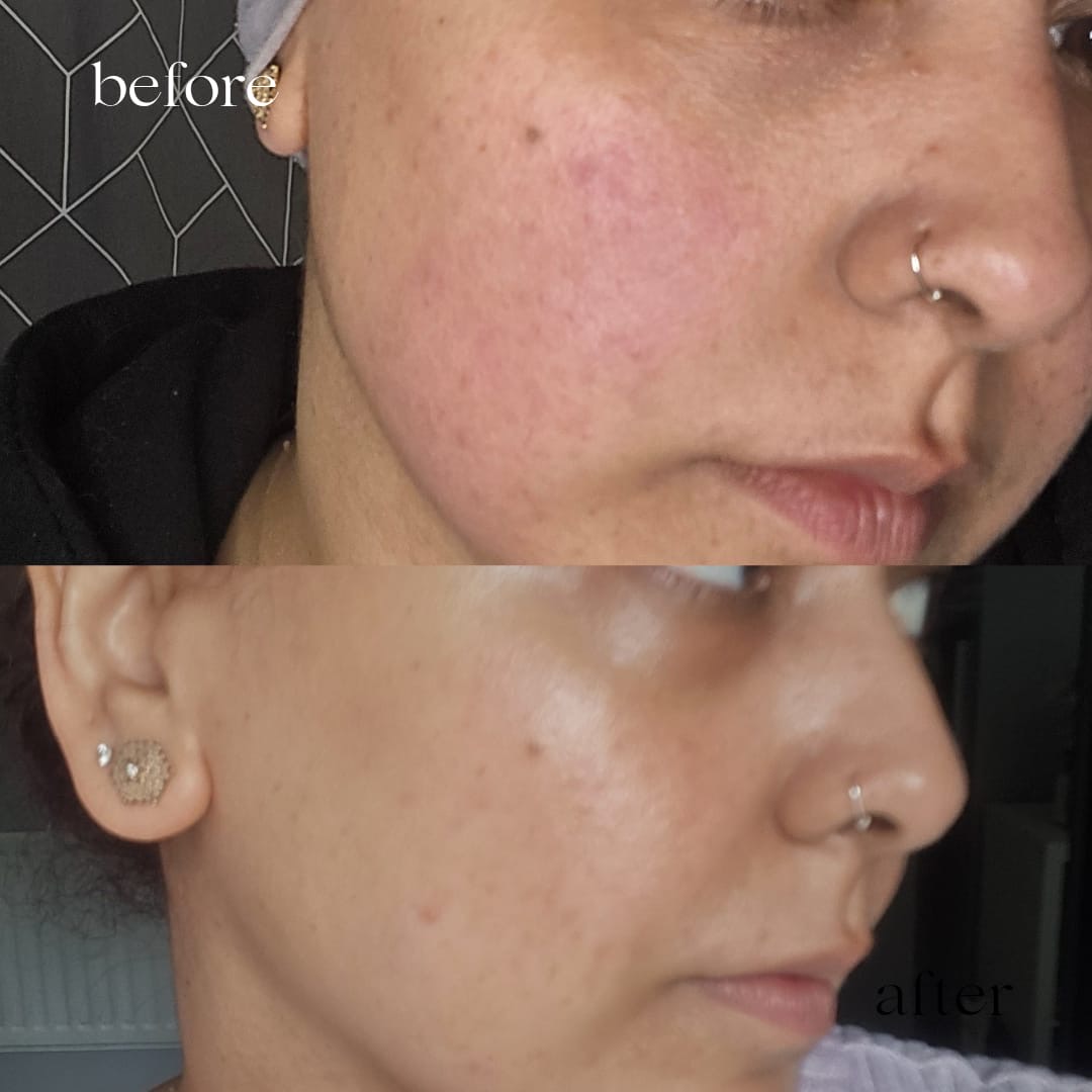Before and after skin treatment, reduced redness