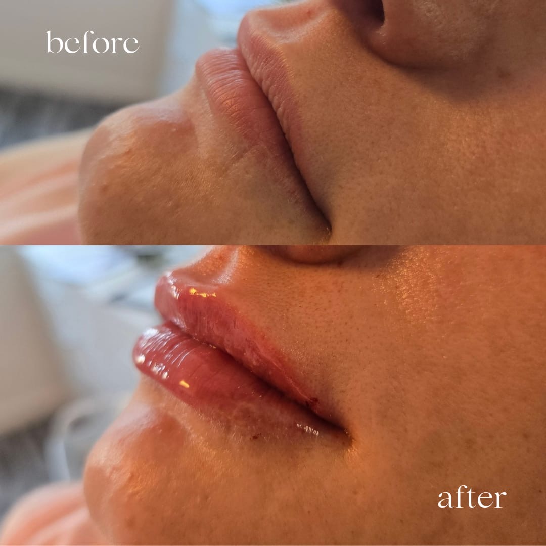 Before and after lip filler, profile view